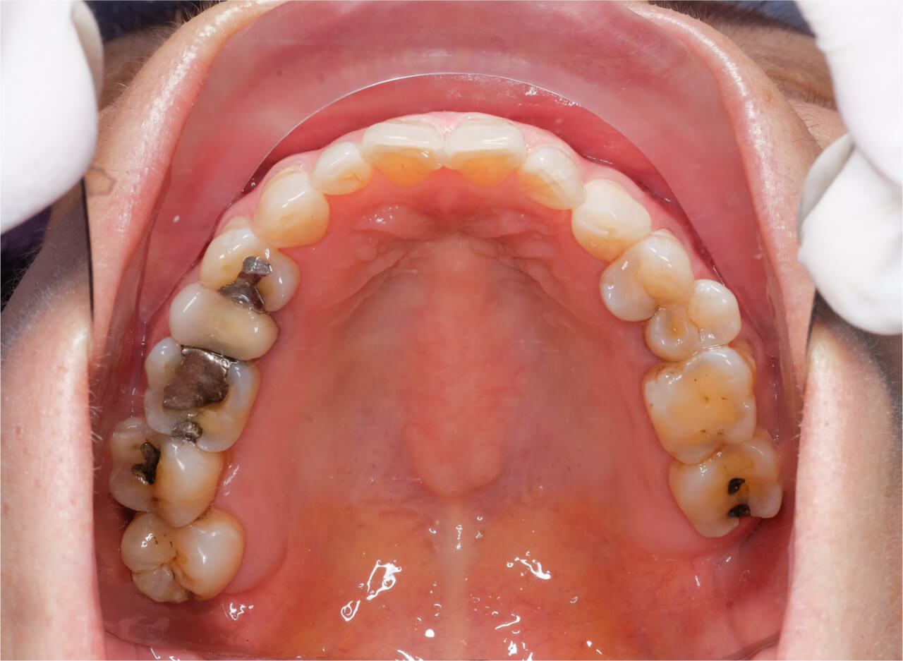 Amalgam Fillings Vs Composite Fillings For Tooth Cavities
