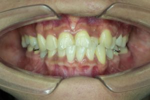 permanent teeth eruption problems