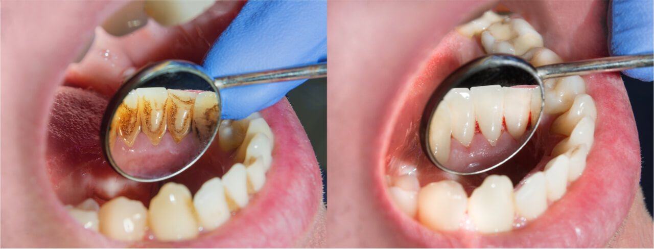deep cleaning for periodontal disease