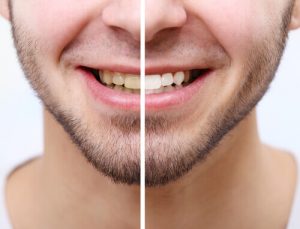 Tooth Bonding Cost vs Teeth Whitening