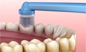 Brushing teeth to remove plaque.