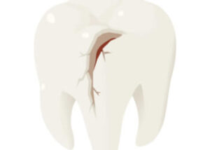 Broken tooth repair kit