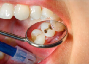 premolar cavity